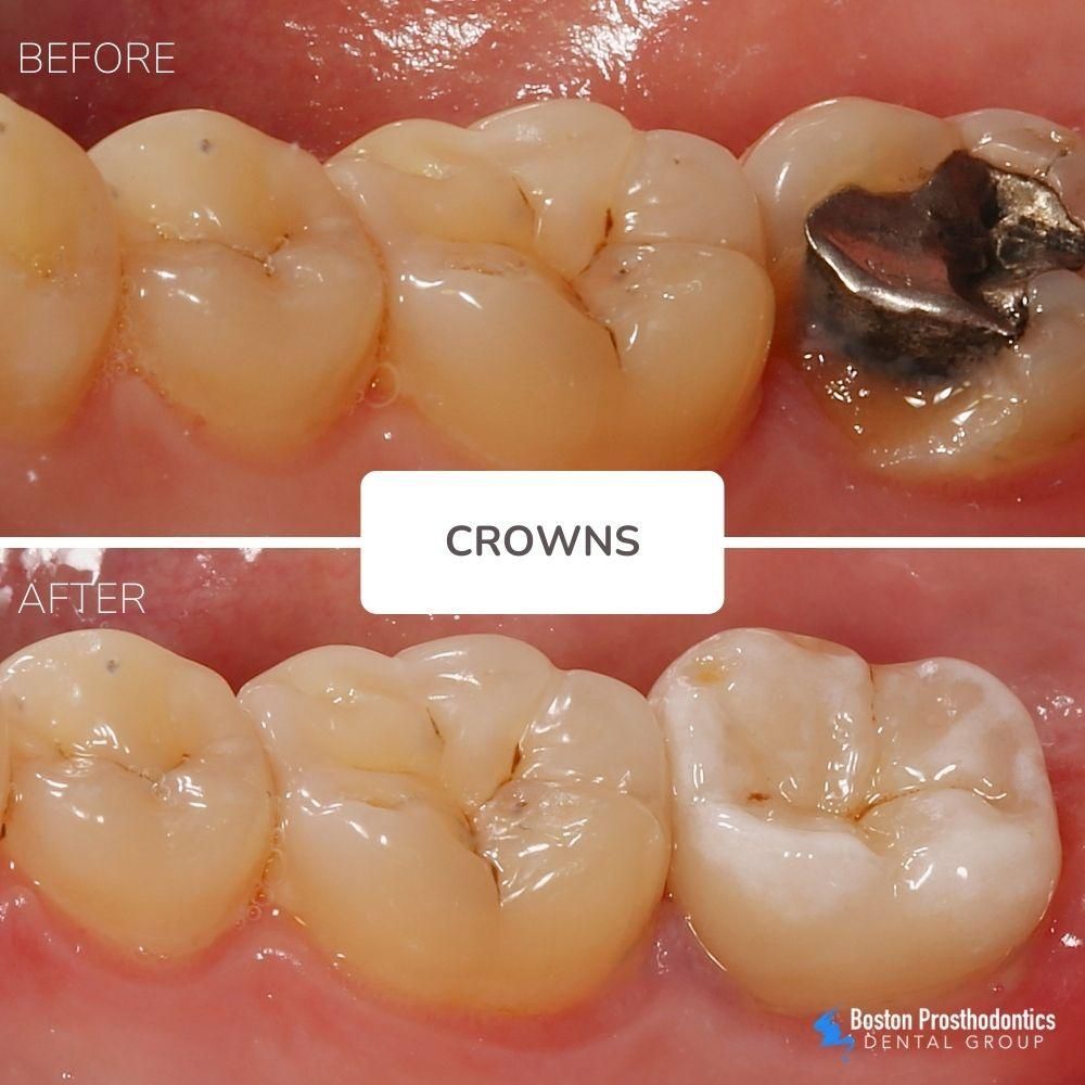 molar crown before after